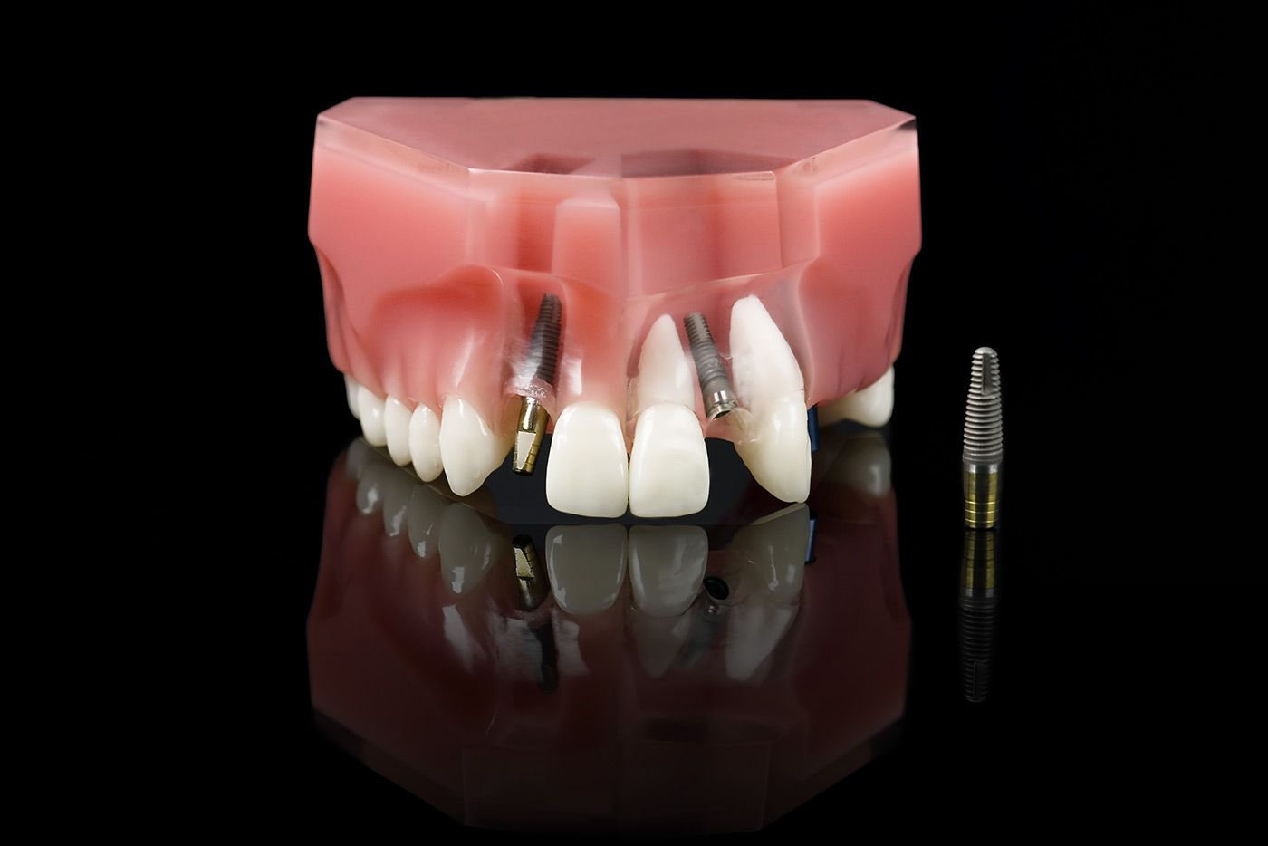 Dental implants in a model mouth